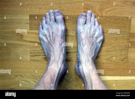 ugly feet pics|Ugly Feet Pictures, Images and Stock Photos